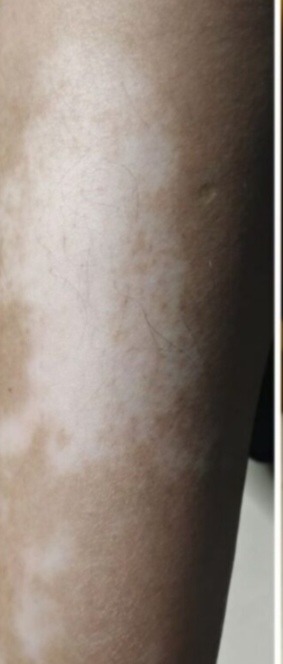 Vitiligo tetoválás előtte – lábszáron