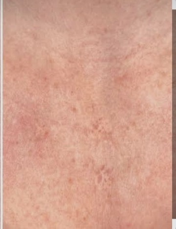 Vitiligo tetoválás utána – nyakon finomított bőrtónus