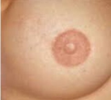 Areola tetoválás utána – egyéni színkeveréssel kialakított areola