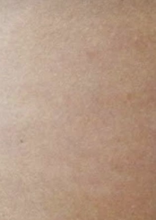 Hegfedő tetoválás utána – pigmentációval harmonizált bőrfelület