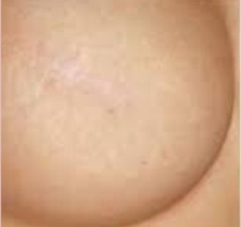 Areola tetoválás előtte – halvány heg a bőrön