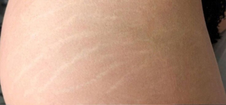 Stria tetoválás előtte – halvány striák a comb bőrén