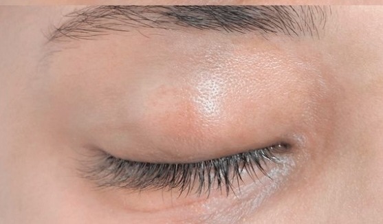 Vitiligo tetoválás utána – szem körüli bőrfelület harmonizálva