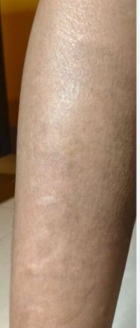 Vitiligo tetoválás utána – lábszáron természetes hatású eredmény
