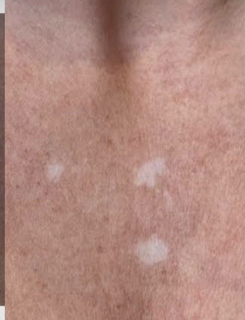 Vitiligo tetoválás előtte – nyakon foltokkal